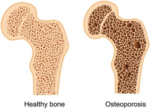 healthy bone vs osteoporotic